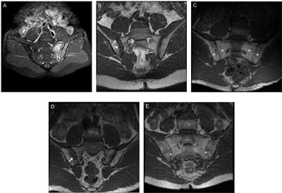 Active Inflammatory and Chronic Structural Damages of Sacroiliac Joint in Patients With Radiographic Axial Spondyloarthritis and Non-Radiographic Axial Spondyloarthritis